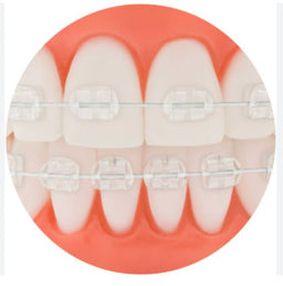 Aesthetic Coated Archwire